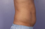 CoolSculpting® Before and after photo