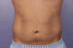 CoolSculpting® Before and after photo