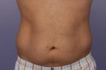 CoolSculpting® Before and after photo