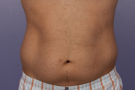 CoolSculpting® before and after photo