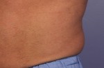 CoolSculpting® Before and after photo