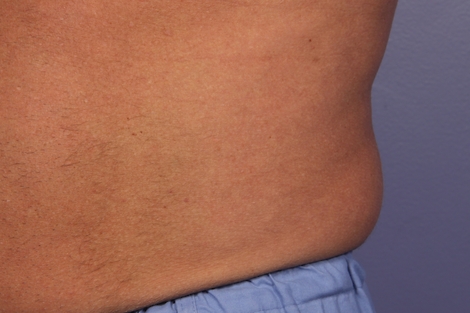 CoolSculpting® before and after photo