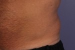 CoolSculpting® Before and after photo