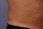 CoolSculpting® Before and after photo