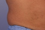 CoolSculpting® Before and after photo