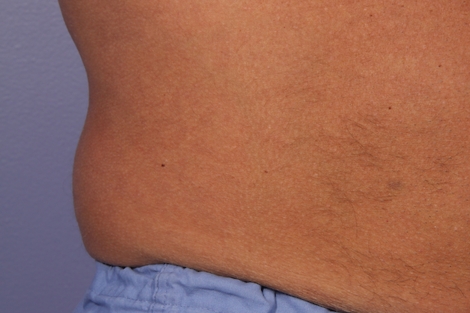 CoolSculpting® before and after photo