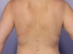 CoolSculpting® Before and after photo