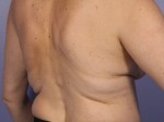 CoolSculpting® Before and after photo