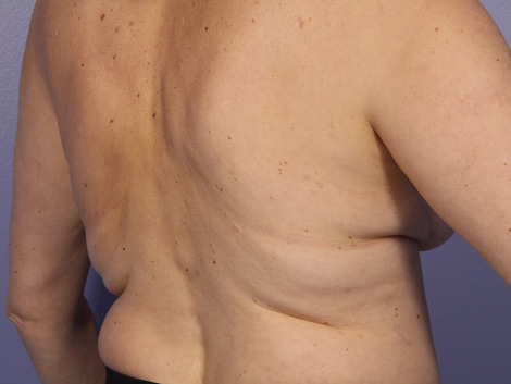 CoolSculpting® before and after photo