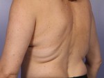 CoolSculpting® Before and after photo