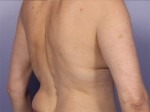 CoolSculpting® Before and after photo