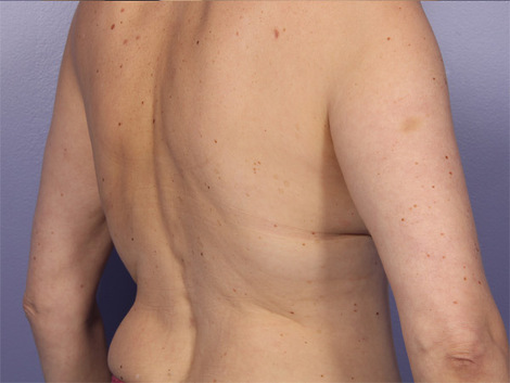 CoolSculpting® before and after photo