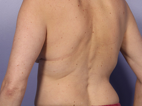 CoolSculpting® before and after photo