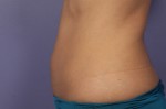 CoolSculpting® Before and after photo