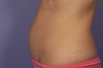 CoolSculpting® Before and after photo