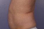 CoolSculpting® Before and after photo