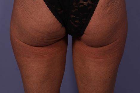 CoolSculpting® before and after photo