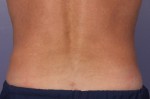 CoolSculpting® Before and after photo
