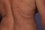 CoolSculpting® Before and after photo