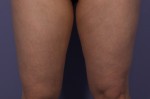 CoolSculpting® Before and after photo