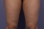CoolSculpting® Before and after photo