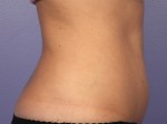 CoolSculpting® Before and after photo