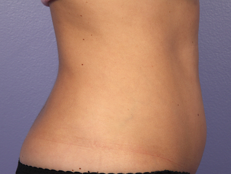 CoolSculpting® before and after photo