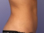 CoolSculpting® Before and after photo