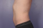 CoolSculpting® Before and after photo