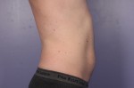 CoolSculpting® Before and after photo