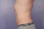 CoolSculpting® Before and after photo