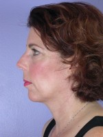 Cheek/Chin Shaping Before and after photo