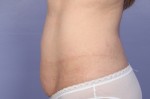 CoolSculpting® Before and after photo