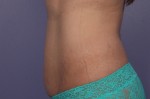 CoolSculpting® Before and after photo