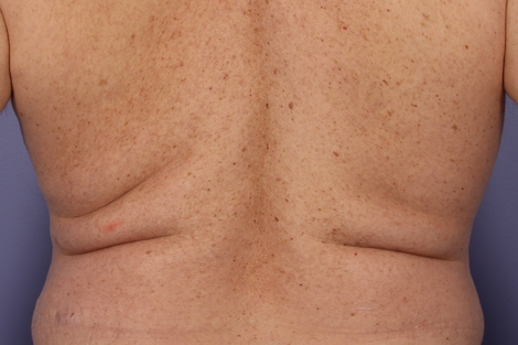 CoolSculpting® before and after photo