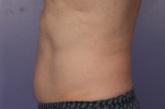 CoolSculpting® Before and after photo