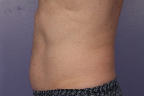 CoolSculpting® before and after photo