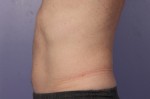 CoolSculpting® Before and after photo