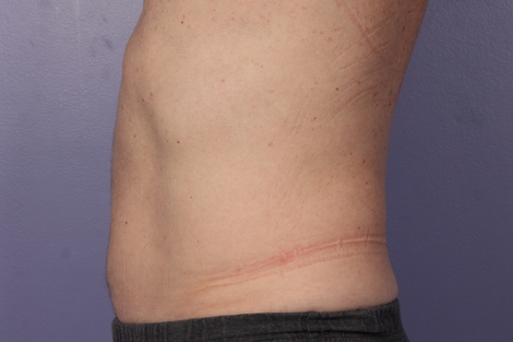 CoolSculpting® before and after photo