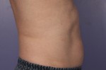 CoolSculpting® Before and after photo