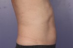 CoolSculpting® Before and after photo