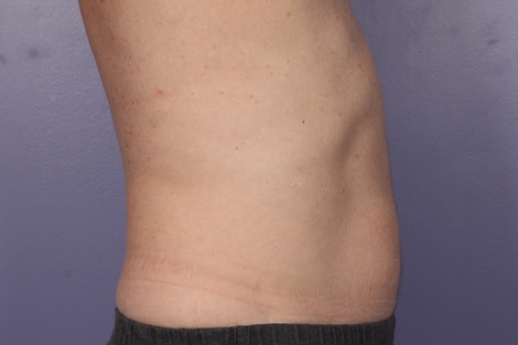 CoolSculpting® before and after photo