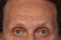 Xeomin before and after photo