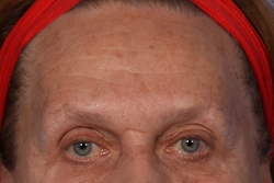 Xeomin before and after photo