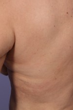 CoolSculpting® Before and after photo