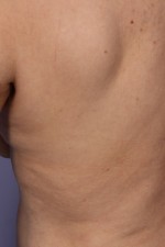 CoolSculpting® Before and after photo