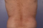 CoolSculpting® Before and after photo