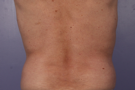 CoolSculpting® before and after photo
