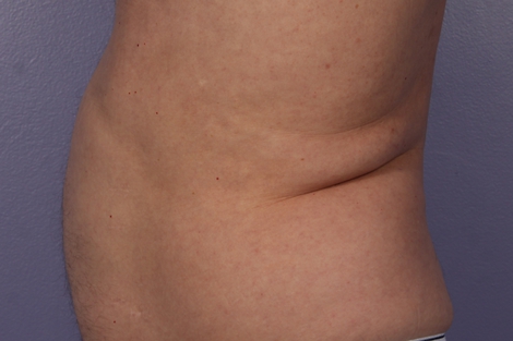 CoolSculpting® before and after photo