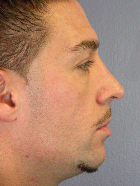 Nose Reshaping before and after photo